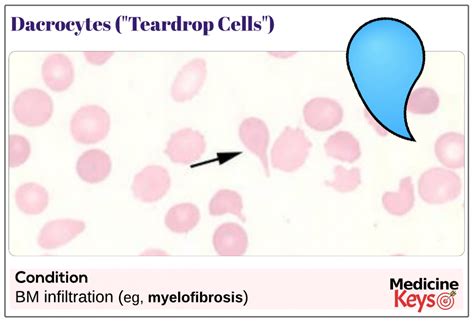 2.15: Tear Cells (Dacrocytes, Teardrops) .